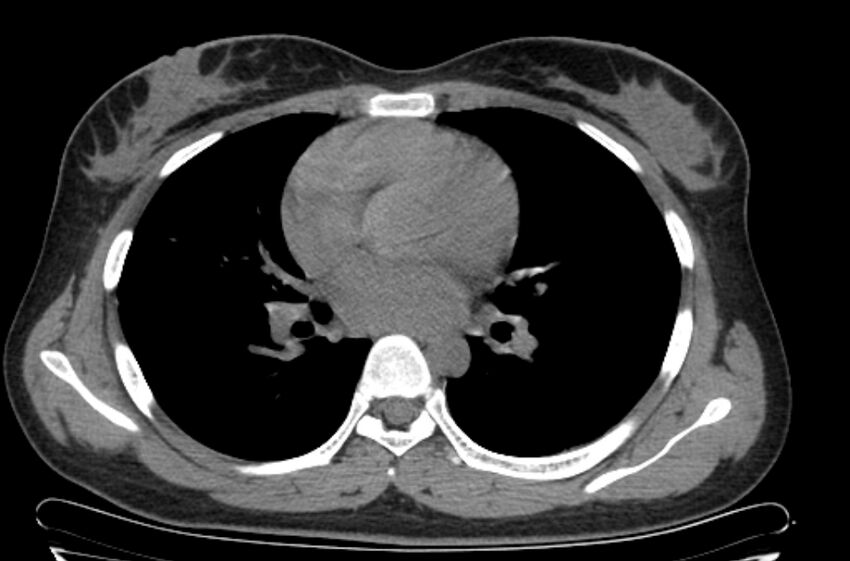Cannonball metastases - uterine choriocarcinoma (Radiopaedia 70137-80173 Axial non-contrast 60).jpg
