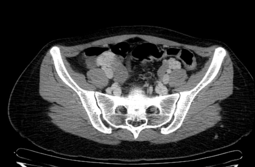 Cannonball metastases - uterine choriocarcinoma (Radiopaedia 70137-80174 A 4).jpg