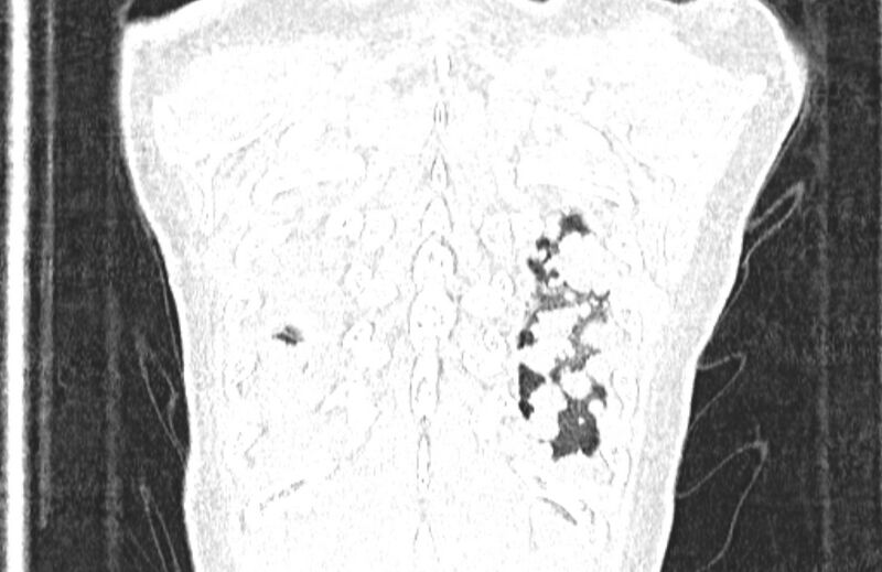 File:Cannonball metastases from breast cancer (Radiopaedia 91024-108569 Coronal lung window 135).jpg