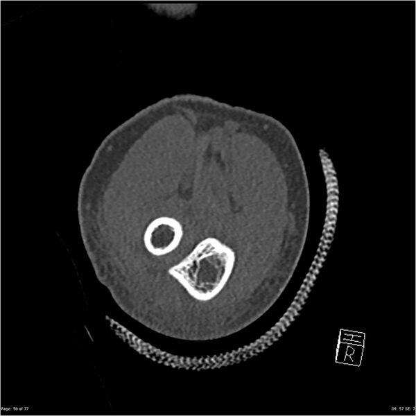 File:Capitellum fracture (Radiopaedia 23352-23426 Coronal bone window 56).jpg
