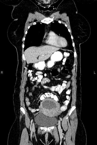 File:Carcinoma of uterine cervix (Radiopaedia 85861-101700 C 11).jpg