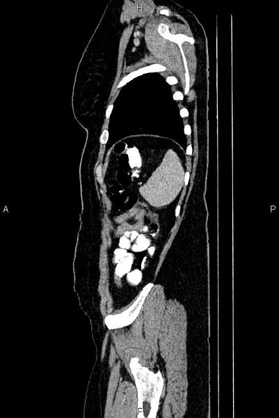 File:Carcinoma of uterine cervix (Radiopaedia 85861-101700 D 77).jpg