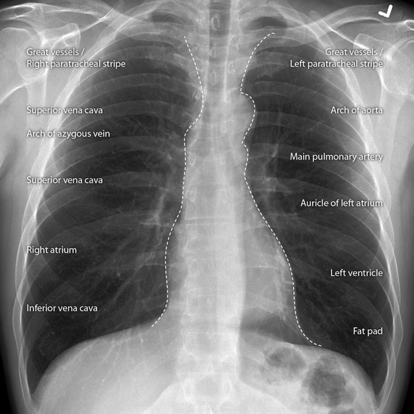 File:Cardiomediastinal outlines on chest x-ray (Radiopaedia 8470-9293 Frontal 1).png