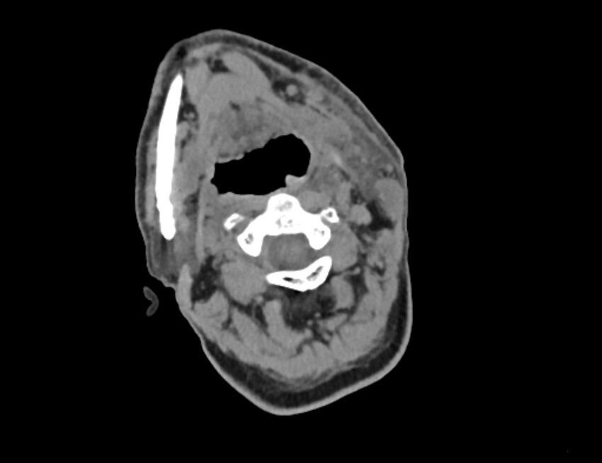 Carotid artery pseudoaneurysm (Radiopaedia 84030-99259 Axial non-contrast 11).jpg