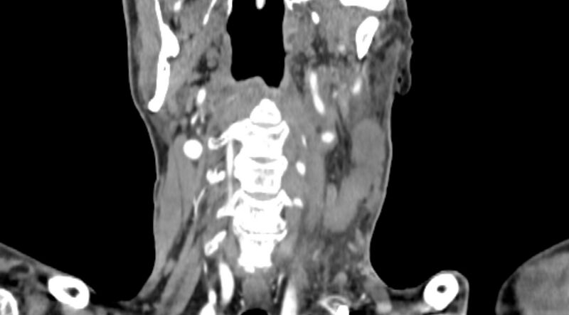 File:Carotid artery pseudoaneurysm (Radiopaedia 84030-99259 D 51).jpg