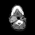 Carotid body tumor (Radiopaedia 27890-28124 A 16).jpg