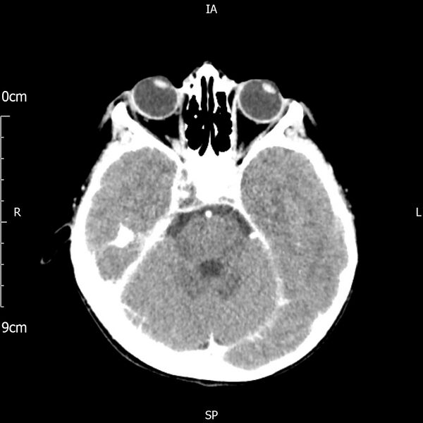 File:Cavernous sinus thrombosis (Radiopaedia 79414-92510 Axial Brain 77).jpg