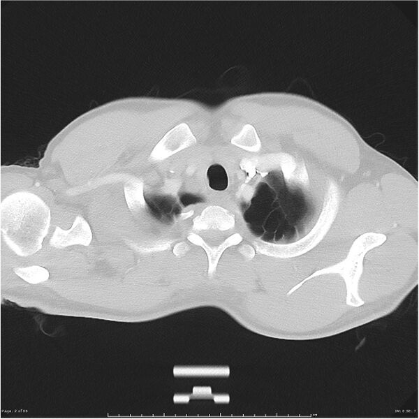 File:Cavitating lung cancer (Radiopaedia 25796-25945 Axial lung window 2).jpg