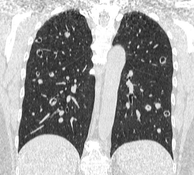 File:Cavitating pulmonary metastases (Radiopaedia 17796-17555 Coronal lung window 18).jpg