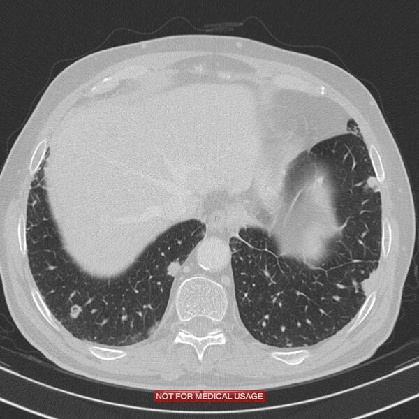 File:Cavitating pulmonary metastases (Radiopaedia 24920-25184 Axial lung window 20).jpg