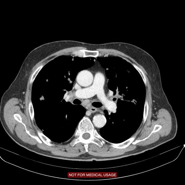 File:Cavitating pulmonary metastases (Radiopaedia 24920-25184 B 11).jpg