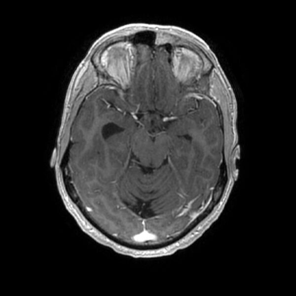 File:Central neurocytoma (Radiopaedia 67618-77021 Axial T1 C+ 10).jpg