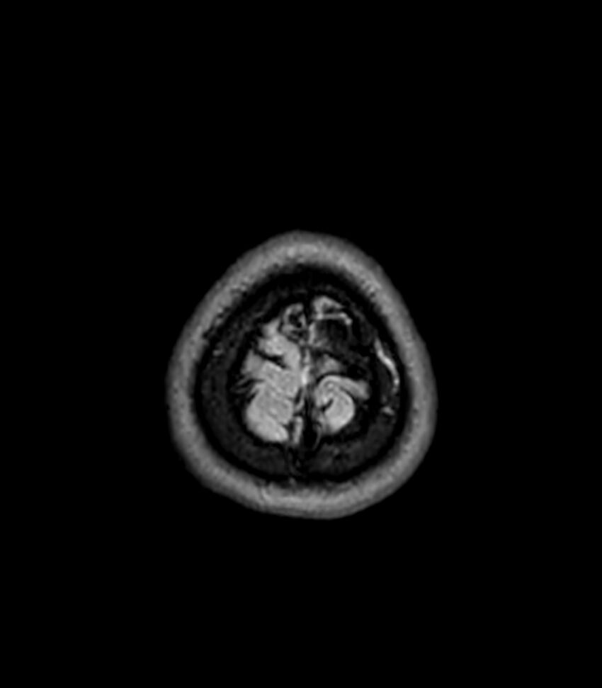 Central neurocytoma (Radiopaedia 79320-92380 Axial FLAIR 37).jpg