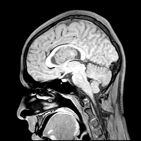 File:Central neurocytoma (Radiopaedia 79320-92380 Sagittal T1 124).jpg