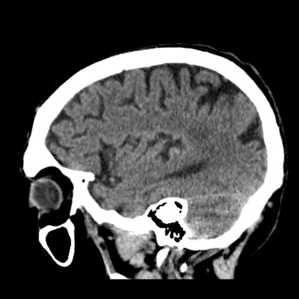 File:Cerebellar hemorrhage (Radiopaedia 27193-27359 C 34).jpg
