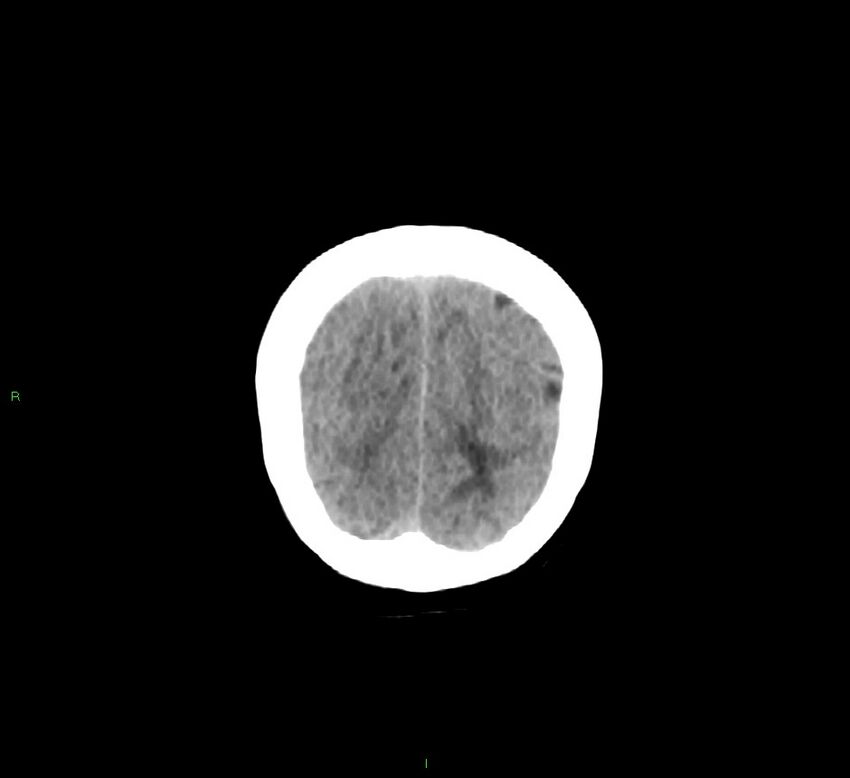 Cerebellar hemorrhage (Radiopaedia 58793-66027 Coronal non-contrast 12).jpg