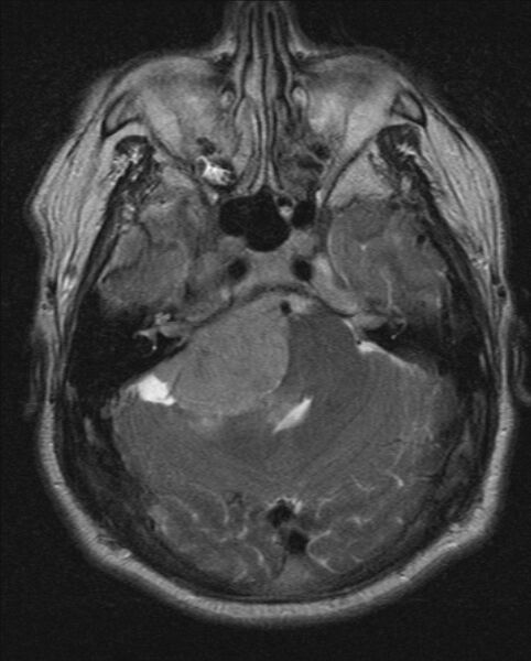 File:Cerebellopontine angle meningioma (Radiopaedia 24459-24764 Axial T2 6).jpg