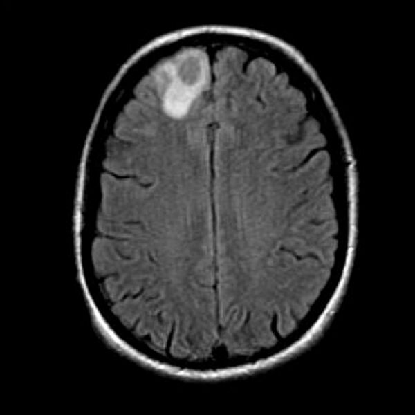 File:Cerebral abscess (Radiopaedia 9975-10538 Axial FLAIR 1).jpg