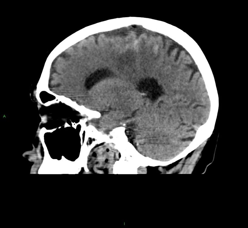 Cerebral amyloid angiopathy-associated lobar intracerebral hemorrhage (Radiopaedia 58376-65511 C 33).jpg