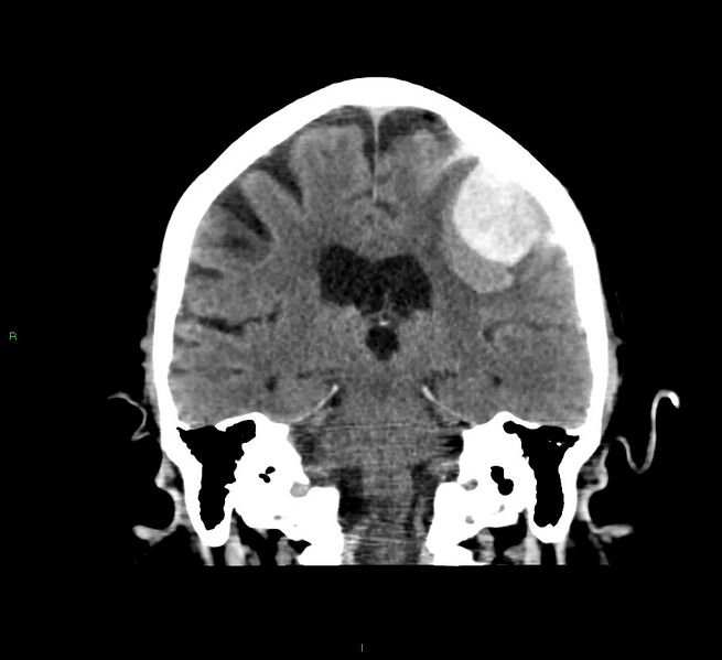 File:Cerebral amyloid angiopathy-associated lobar intracerebral hemorrhage (Radiopaedia 58376-65511 Coronal non-contrast 30).jpg