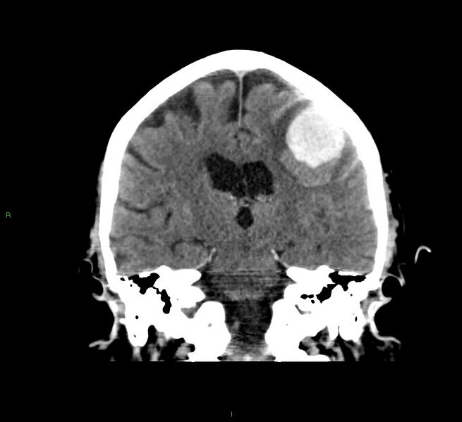 File:Cerebral amyloid angiopathy-associated lobar intracerebral hemorrhage (Radiopaedia 58376-65511 Coronal non-contrast 32).jpg