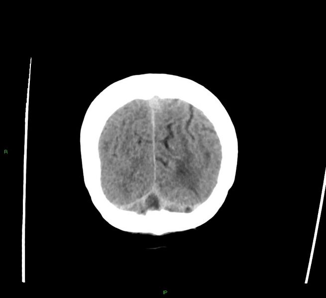 File:Cerebral amyloid angiopathy-associated lobar intracerebral hemorrhage (Radiopaedia 58378-65516 Coronal non-contrast 10).jpg