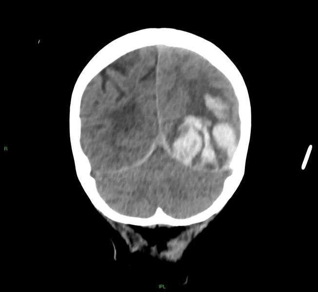 File:Cerebral amyloid angiopathy-associated lobar intracerebral hemorrhage (Radiopaedia 58754-65975 Coronal non-contrast 18).jpg