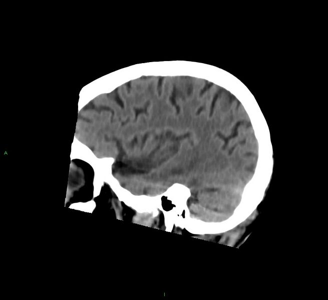 File:Cerebral amyloid angiopathy-associated lobar intracerebral hemorrhage (Radiopaedia 58758-65980 C 41).jpg