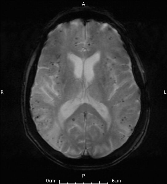 File:Cerebral amyloid angiopathy related inflammation (Radiopaedia 72772-83415 Axial SWI 13).jpg
