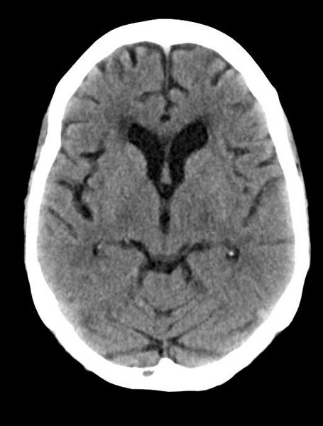 File:Cerebral aneurysm with rupture (Radiopaedia 29933-30457 Axial non-contrast 11).jpg