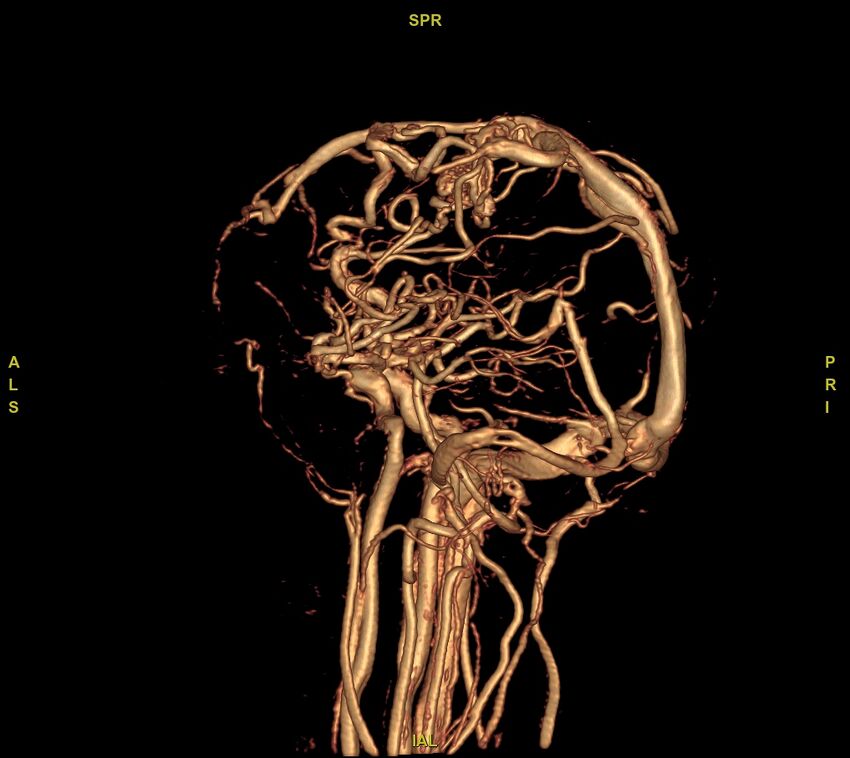 Cerebral arteriovenous malformation (Radiopaedia 61964-70029 VRT 6).jpg