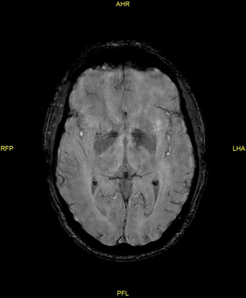 File:Cerebral autosomal dominant arteriopathy with subcortical infarcts and leukoencephalopathy (CADASIL) (Radiopaedia 86108-102054 Axial SWI 53).jpg