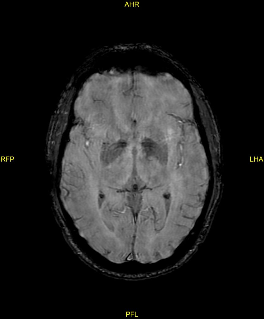 Cerebral autosomal dominant arteriopathy with subcortical infarcts and leukoencephalopathy (CADASIL) (Radiopaedia 86108-102054 Axial SWI 53).jpg