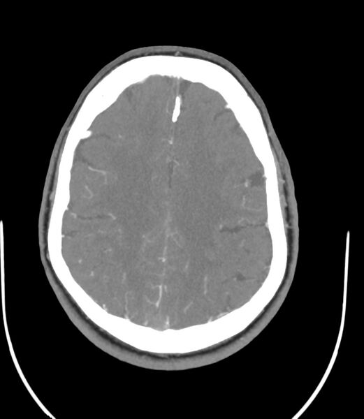 File:Cerebral dural venous sinus thrombosis (Radiopaedia 86514-102576 A 72).jpg