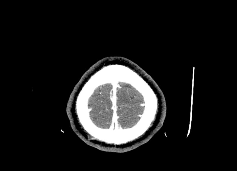 File:Cerebral edema (Radiopaedia 82519-96661 B 8).jpg