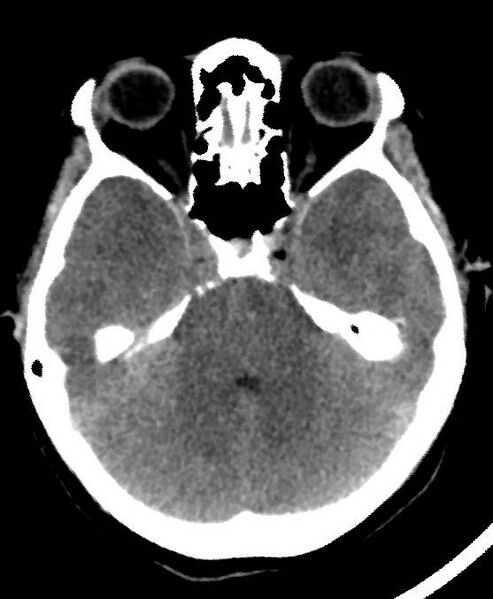 File:Cerebral edema due to severe hyponatremia (Radiopaedia 89826-106937 Axial non-contrast 27).jpg