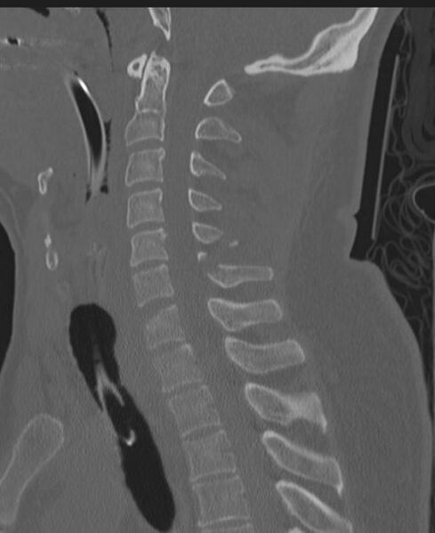 File:Cerebral hemorrhagic contusions and cervical spine fractures (Radiopaedia 32865-33841 Sagittal bone window 53).jpg