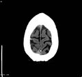 Cerebral vein thrombosis (Radiopaedia 4408-6628 Axial non-contrast 6).jpg