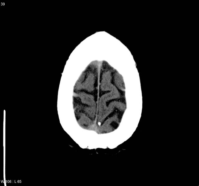 File:Cerebral vein thrombosis (Radiopaedia 4408-6628 Axial non-contrast 6).jpg