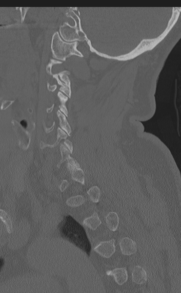 File:Cervical canal stenosis due to ossification of the posterior longitudinal ligament (Radiopaedia 47260-51823 Sagittal bone window 22).png