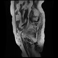 Cervical carcinoma (Radiopaedia 78847-91705 Sagittal T2 3).jpg