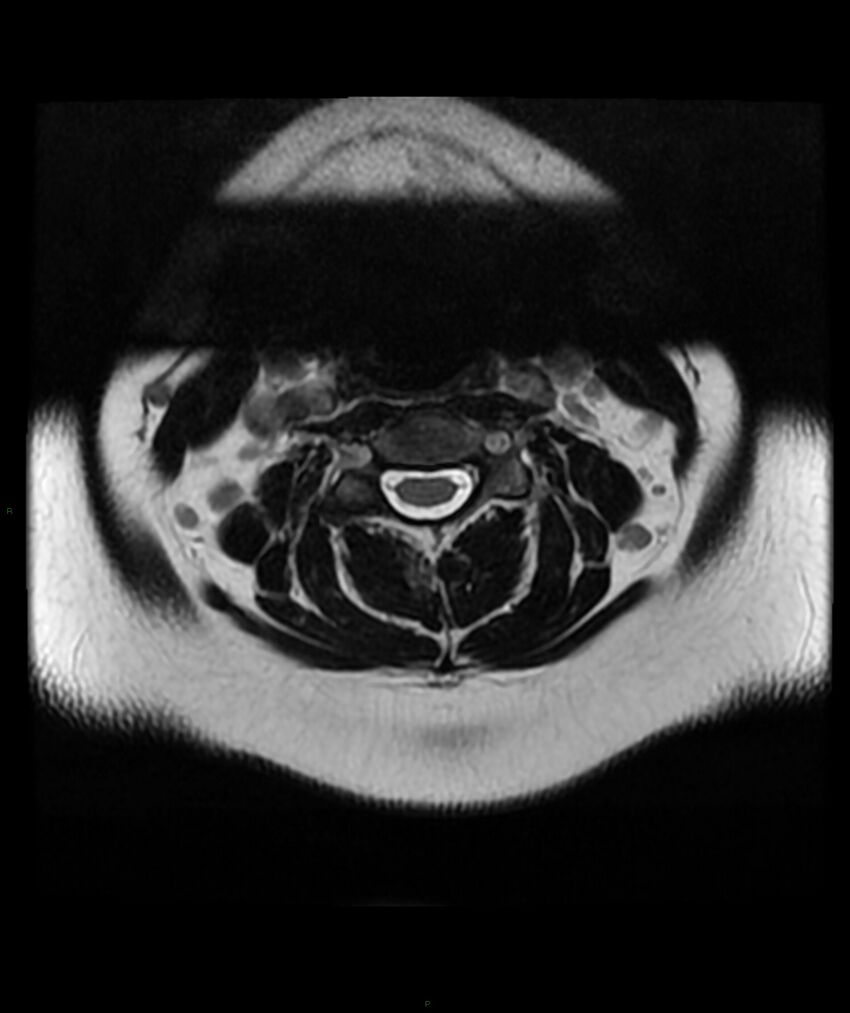 Cervical disc prolapse (Radiopaedia 80258-93598 Axial T2 13).jpg