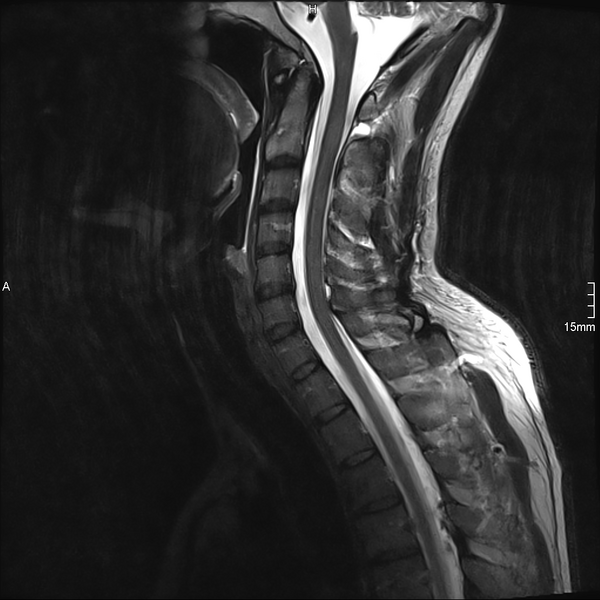 File:Cervical dural CSF leak on MRI and CT treated by blood patch (Radiopaedia 49748-54995 Sagittal T2 6).png