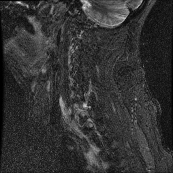 File:Cervical fracture and dislocation with locked facet (Radiopaedia 31837-32781 Sagittal STIR 16).jpg