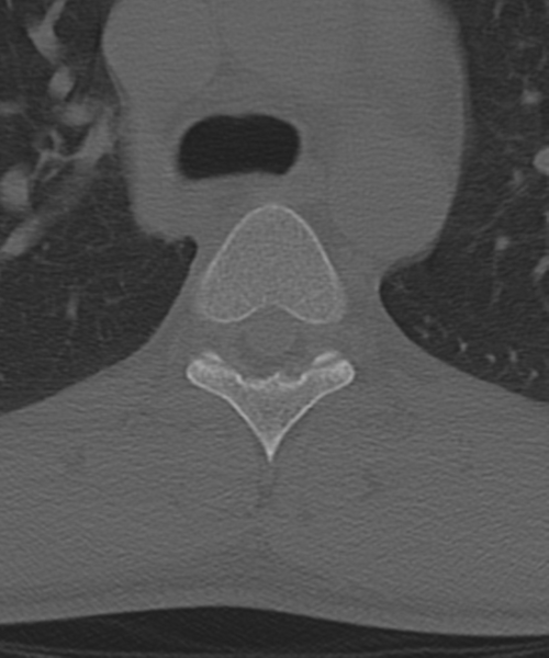 File:Cervical intercalary bone (Radiopaedia 35211-36748 Axial bone window 83).png