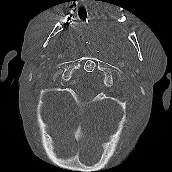 File:Cervical spine fractures with vertebral artery dissection (Radiopaedia 32135-33078 Axial bone window 69).jpg