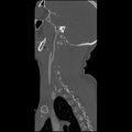 Cervical spine fractures with vertebral artery dissection (Radiopaedia 32135-33078 Sagittal bone window 6).jpg
