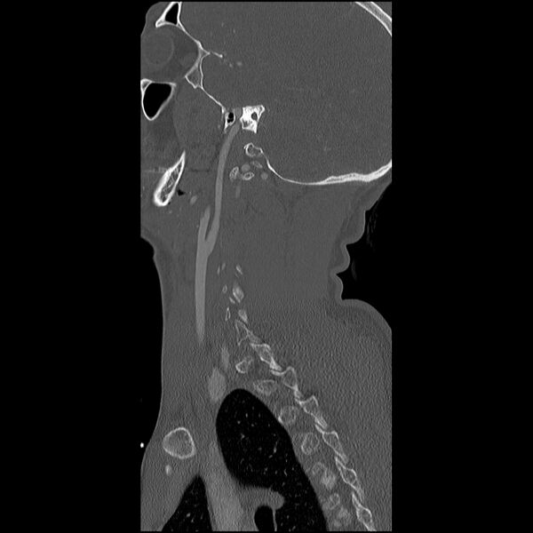 File:Cervical spine fractures with vertebral artery dissection (Radiopaedia 32135-33078 Sagittal bone window 6).jpg