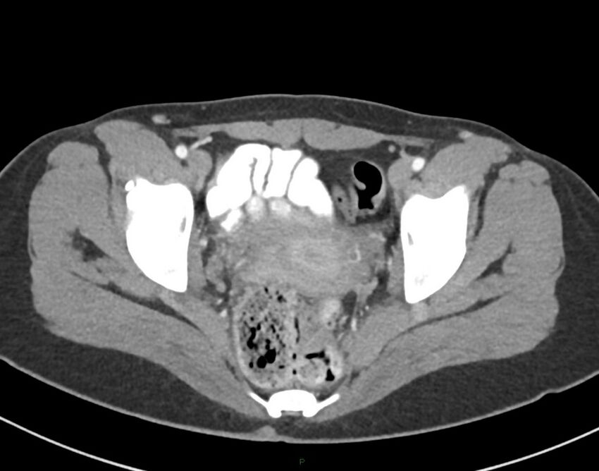 Cesarean scar endometriosis (Radiopaedia 82925-97262 A 78).jpg