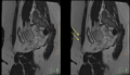 Cesarian scar endometriosis (Radiopaedia 68495-78306 D 7).png